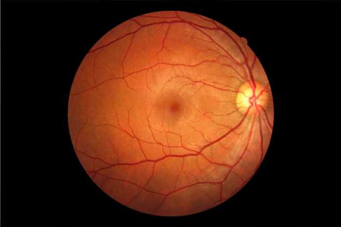 Macula normal retinal showing retina au