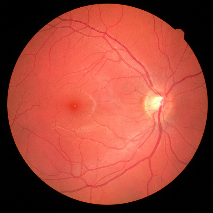 Macula prone