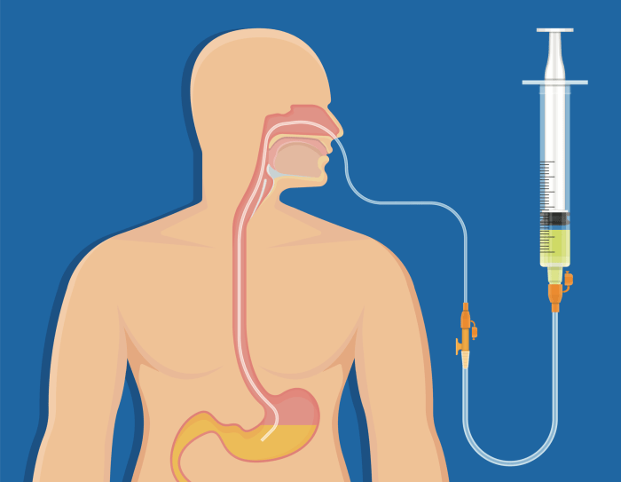 Nurseslabs nclex disorders gastrointestinal